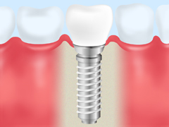 ［画像］インプラント治療