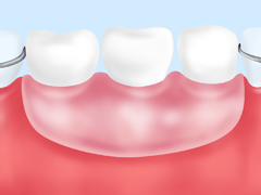 ［画像］入れ歯治療