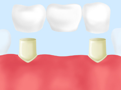 ［画像］ブリッジ治療