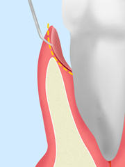 ［画像］歯周ポケット掻爬（そうは）術