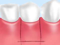 ［画像］FGG（遊離歯肉移植）